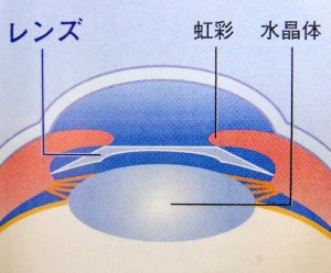 眼内コンタクト手術