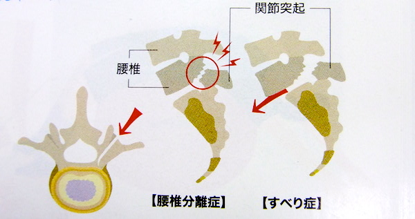 腰椎分離症とすべり症