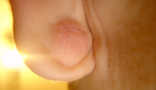 耳たぶ粉瘤